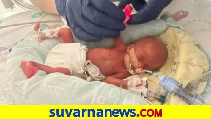 A teenager gave birth to a premature baby newborn weighed 325 grams akb A teenager gave birth to a premature baby newborn weighed 325 grams akb