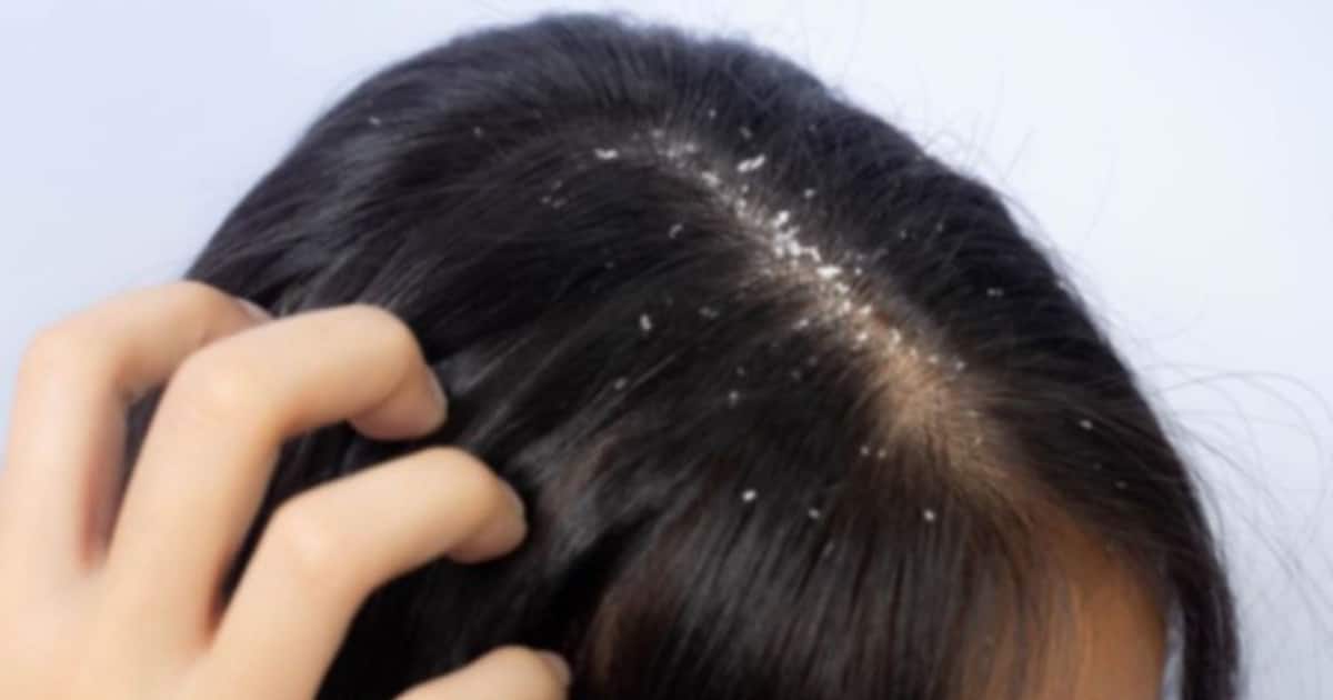 Aloe Vera to baking soda: 5 home remedies you can try to get rid of dandruff