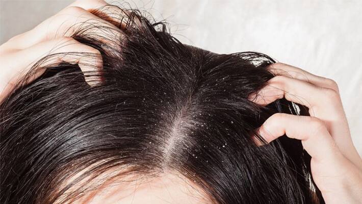 Easy Remedies To Get Rid of Dandruff Naturally Easy Remedies To Get Rid of Dandruff Naturally