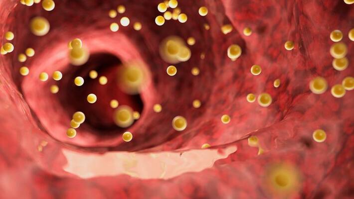 signs of high cholesterol do not ignore these symptoms signs of high cholesterol do not ignore these symptoms