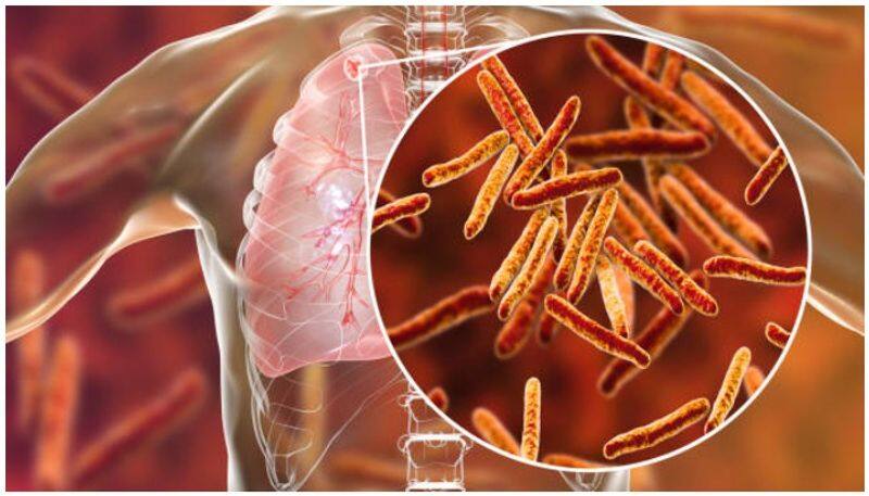 What is Tuberculosis (TB)? Know symptoms, treatment and how it spreads RBA