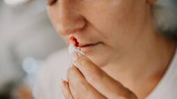 How to stop Nose Bleeding in summer? rsl