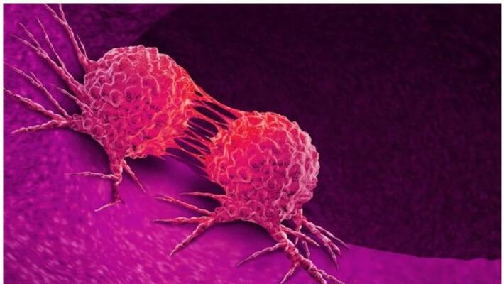 Colon Cancer Cases Increasing Among Indians Ways To Mitigate The Risk Colon Cancer Cases Increasing Among Indians Ways To Mitigate The Risk