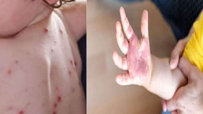 Tomato flu can be a minor forgetfulness, learn how to protect children and yourself BDD Tomato flu can be a minor forgetfulness, learn how to protect children and yourself BDD