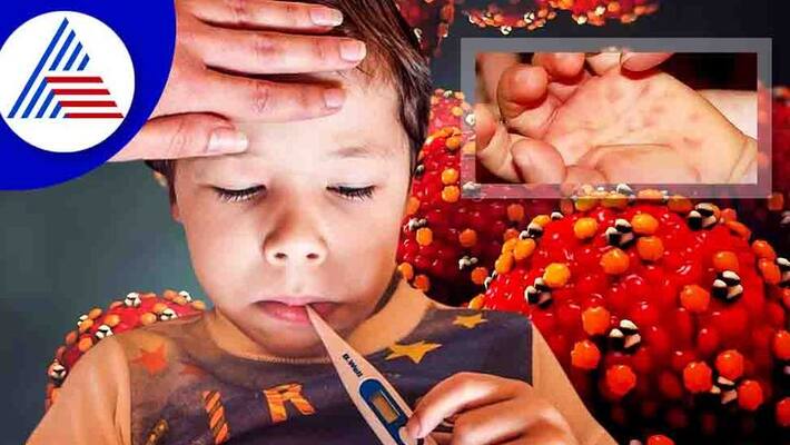 Tomato Fever In Kerala; High Alert Declared In The State Vin Tomato Fever In Kerala; High Alert Declared In The State Vin