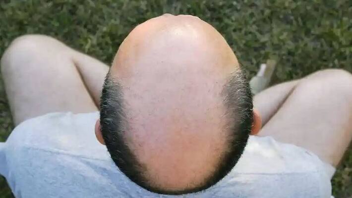 Calling a man bald is sexual harassment employment tribunal rules Calling a man bald is sexual harassment employment tribunal rules