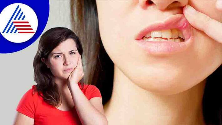 What Causes Mouth Ulcers and How to Treat Them Vin What Causes Mouth Ulcers and How to Treat Them Vin