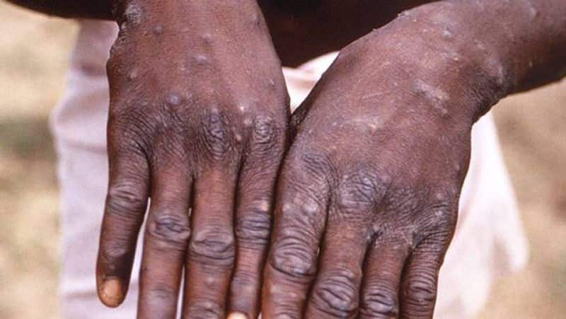 After Covid 19, Monkey pox spread several countries 
