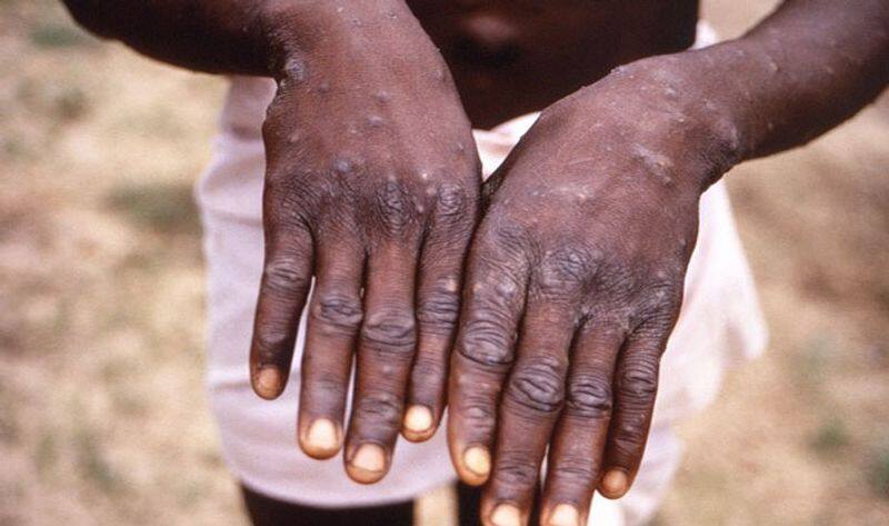 one more confirmed monkey pox infection in kerala