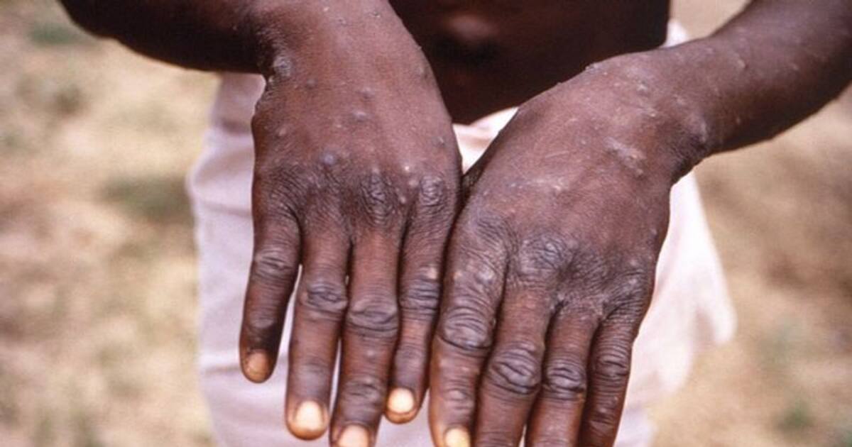 ஐக்கிய அரபு அமீரகத்தில் ஒருவருக்கு பாதிப்பு... புது பீதியை ஏற்படுத்தி வரும் குரங்கு அம்மை..!