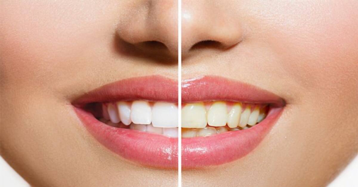 Teeth Whitening: பற்கள் மஞ்சளா இருக்கா?  உங்கள் பற்கள் பளிச்சென்று வெண்மையாக மாற.. இந்த டிப்ஸ் பாலோ பண்ணுங்கோ