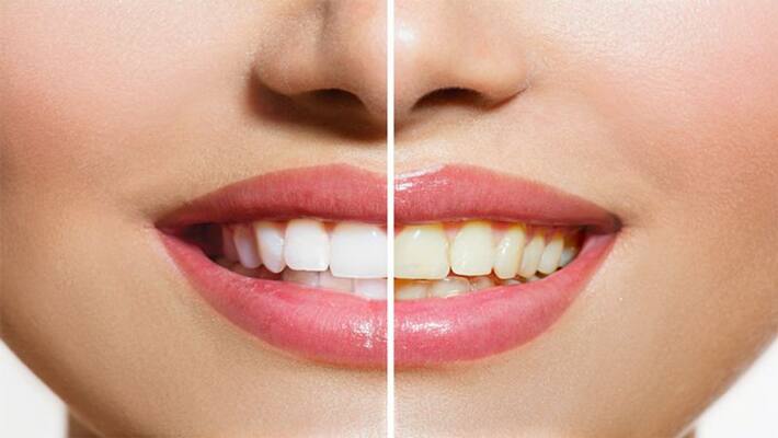 Home Remedies tips for yellow Teeth Whitening Home Remedies tips for yellow Teeth Whitening