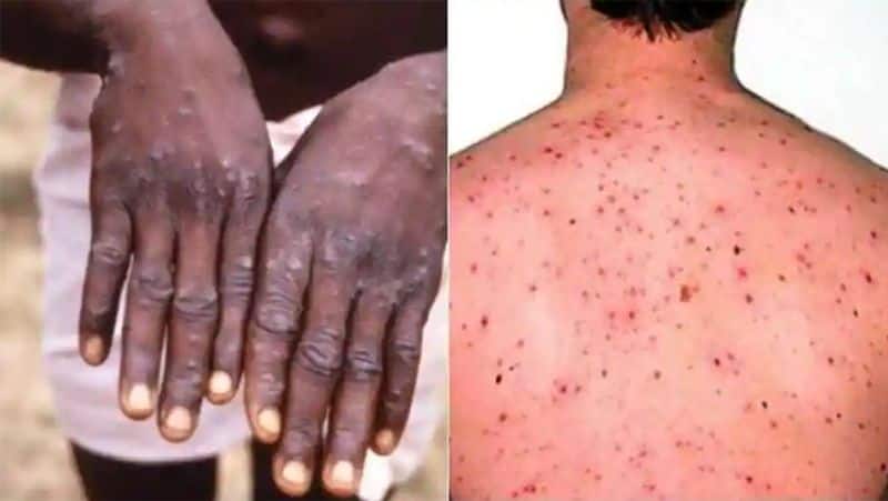 monkeypox : WHO confirms 80 cases in 11 countries