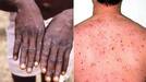 More than 100 monkeypox cases in Europe .. Emergency meeting Managed by WHO