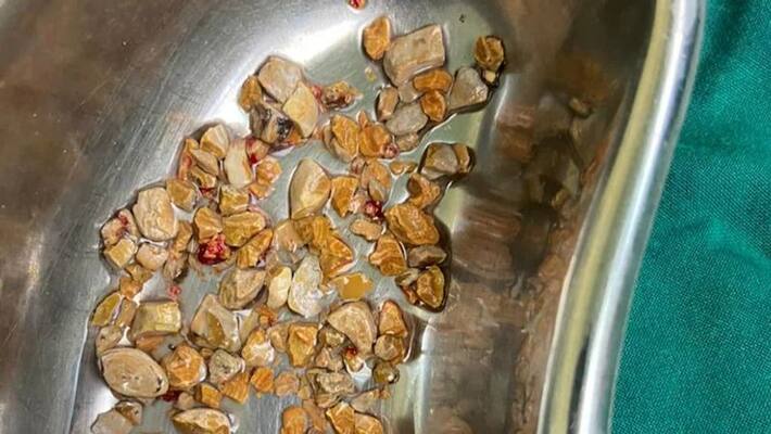 Doctors remove 206 kidney stones in 1 hour from 56-year-old man in Hyderabad Doctors remove 206 kidney stones in 1 hour from 56-year-old man in Hyderabad
