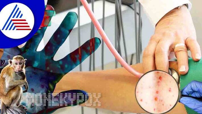 World Monkeypox Outbreak Tops 50,000 Cases: WHO Vin World Monkeypox Outbreak Tops 50,000 Cases: WHO Vin