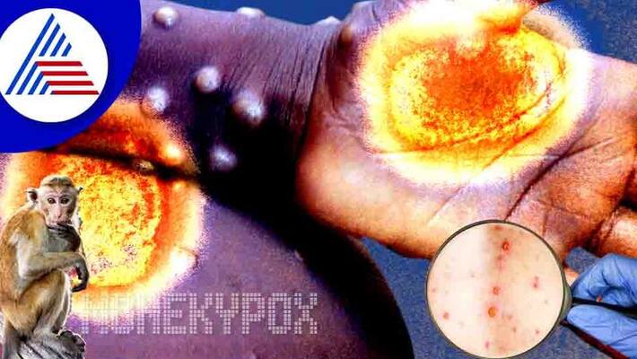 Monkeypox Outbreak Five Myths And Facts About This Viral Infection Vin Monkeypox Outbreak Five Myths And Facts About This Viral Infection Vin