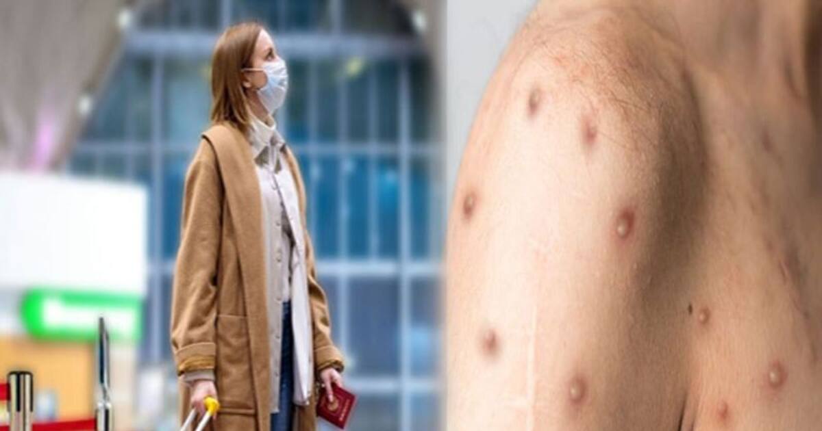 Monkeypox virus:  உலகை அச்சுறுத்தும் அடுத்த உயிர்கொல்லி நோய்...? அவசர நிலையை அறிவித்த உலக சுகாதார நிறுவனம்