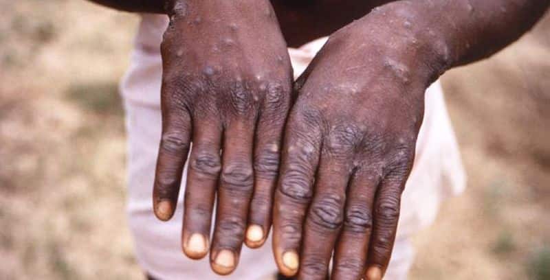 Unlikely Monkeypox Outbreak Will Turn Into A Global Pandemic WHO