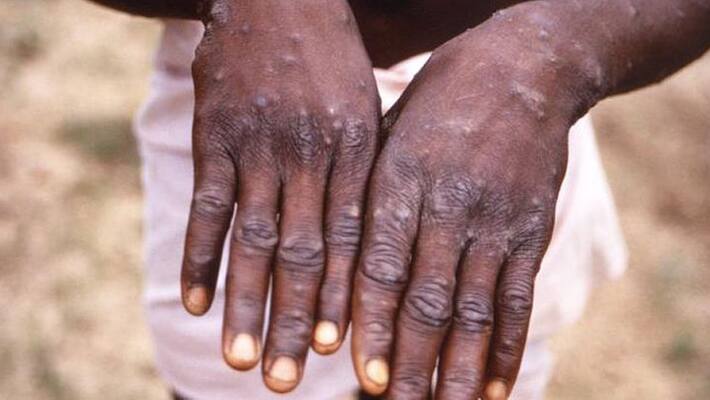 Individual with monkeypox admitted to Delhi hospital, had travelled abroad - adt Individual with monkeypox admitted to Delhi hospital, had travelled abroad - adt