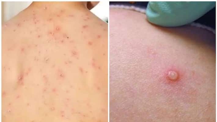 monkeypox cases are higher among men especially homosexuals monkeypox cases are higher among men especially homosexuals
