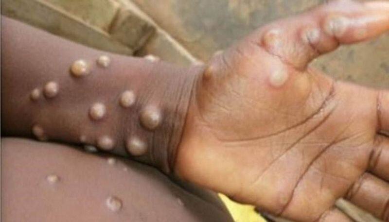 monkey pox symptoms for andhra child from saudi arabia