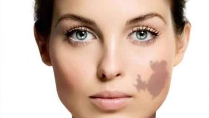People with these scars on their bodies are considered lucky, find out what Samudra Shasra says bpsb People with these scars on their bodies are considered lucky, find out what Samudra Shasra says bpsb