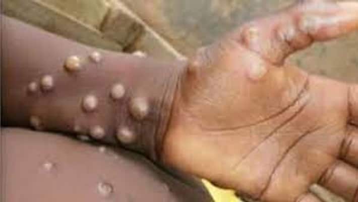 India first Monkeypox case confirmed Centre steps up surveillance know about all about virus gcw India first Monkeypox case confirmed Centre steps up surveillance know about all about virus gcw