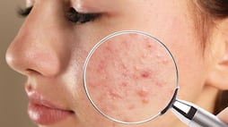 home remedies to keep pimples and acne at bay
