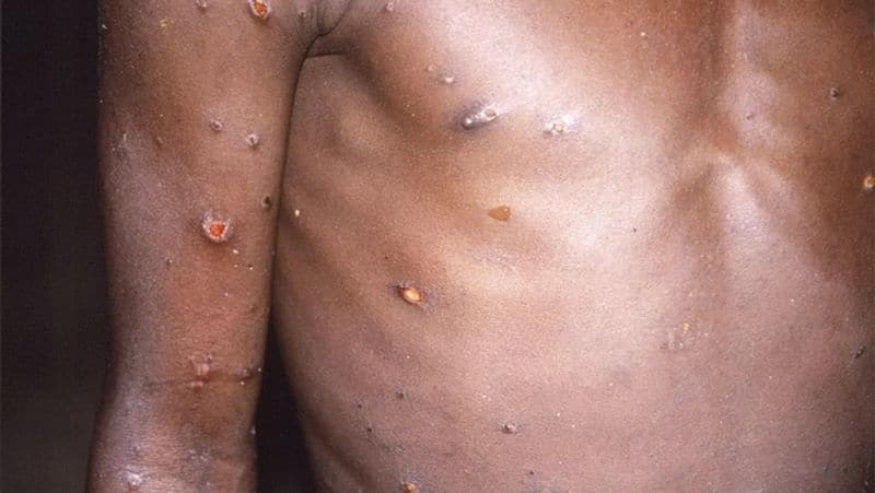 Monkeypox symptom in a person returning from UAE to Kerala 