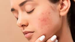 natural ways to get Rid of pimples as fast as possible