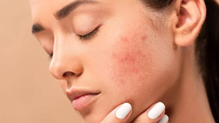 easy home remedies for acne easy home remedies for acne