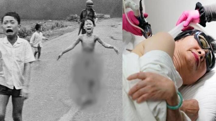 Napalm girl in iconic Vietnam war photo gets final skin treatment in US vva Napalm girl in iconic Vietnam war photo gets final skin treatment in US vva