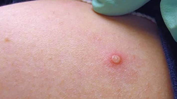 monkeypox symptoms and available treatments monkeypox symptoms and available treatments