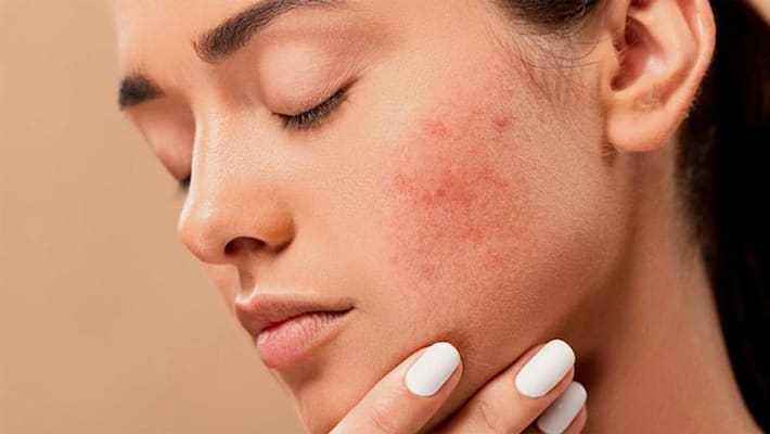 taking birth control pill to get rid of acne problem taking birth control pill to get rid of acne problem