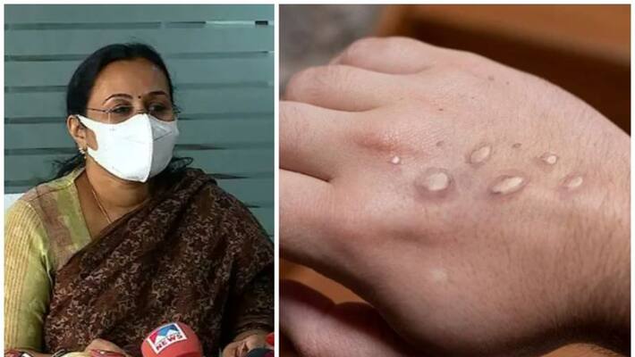 Keralam To Strengthen Defense against Monkeypox Keralam To Strengthen Defense against Monkeypox