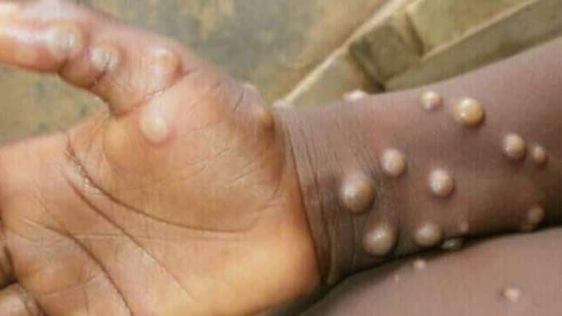 31 year old Nigerian woman tests positive for Monkey pox in Delhi