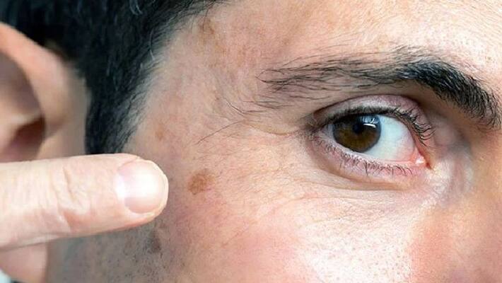 skin cancer is higher among males than females says a report skin cancer is higher among males than females says a report