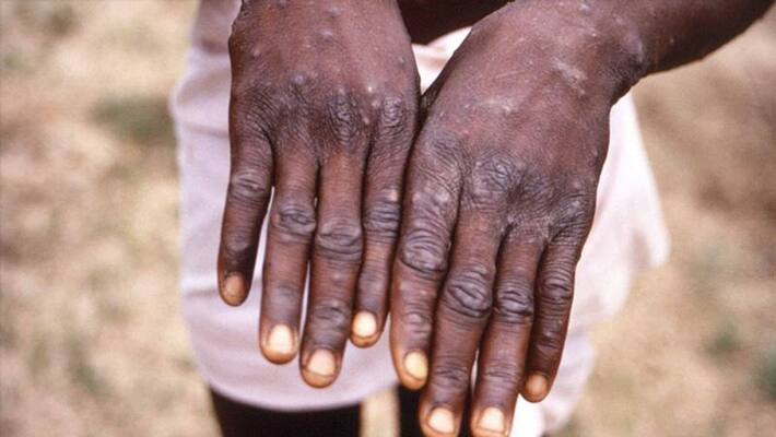 Nigerian man tests positive for monkeypox virus; 2nd case in Delhi, 6th countrywide snt Nigerian man tests positive for monkeypox virus; 2nd case in Delhi, 6th countrywide snt
