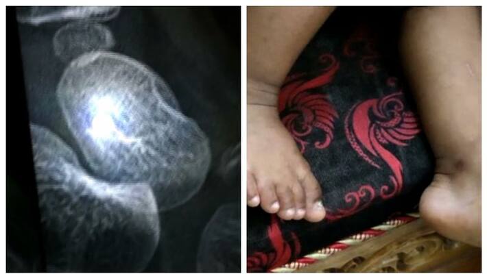 The needle stuck in the baby s leg in the neyyattinkara government hospital The needle stuck in the baby s leg in the neyyattinkara government hospital