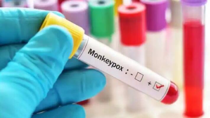 Monkeypox new case in Delhi, Monekypox positive cases in India, What is Monkeypox, DVG Monkeypox new case in Delhi, Monekypox positive cases in India, What is Monkeypox, DVG