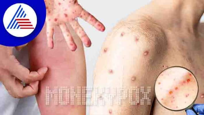 Single Lesion Could Also Hint At Monkeypox Infection, UK Health Agency Vin Single Lesion Could Also Hint At Monkeypox Infection, UK Health Agency Vin
