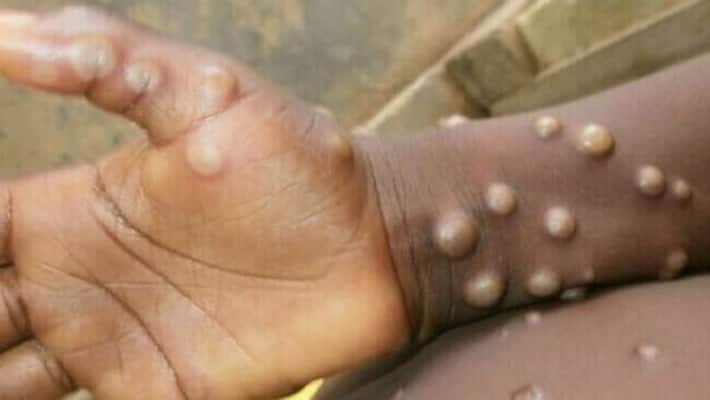 Foods that help to stay away from monkeypox ABSC Foods that help to stay away from monkeypox ABSC