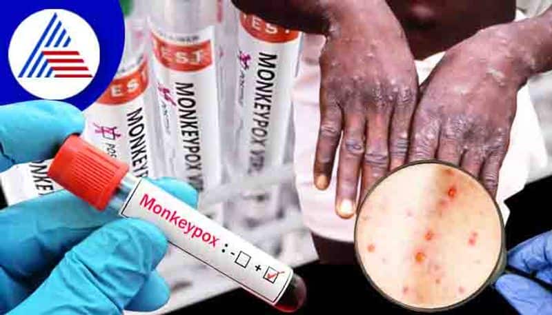 Monkeypox for 4 people in Tamil Nadu? What does Minister Subramanian say?