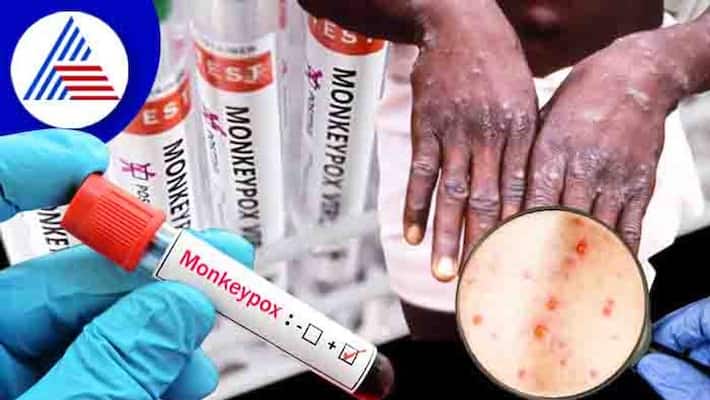 Suspected MonkeyPox death in Thrissur, Sample result awaited Suspected MonkeyPox death in Thrissur, Sample result awaited