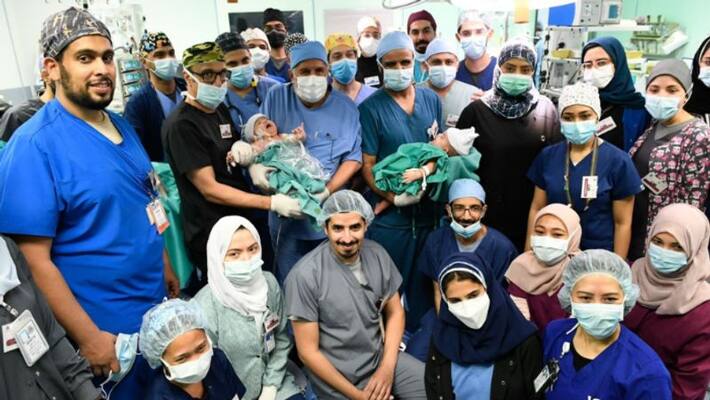 Team of 28 Saudi doctors successfully separate Yemeni Siamese twins Team of 28 Saudi doctors successfully separate Yemeni Siamese twins