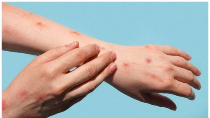 WHO announces 'mpox' as synonym for Moonkeypox; check details - adt WHO announces 'mpox' as synonym for Moonkeypox; check details - adt