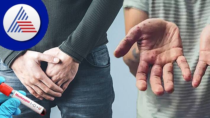 Study finds two symptoms of Monkeypox that could appear on your genitals Vin Study finds two symptoms of Monkeypox that could appear on your genitals Vin