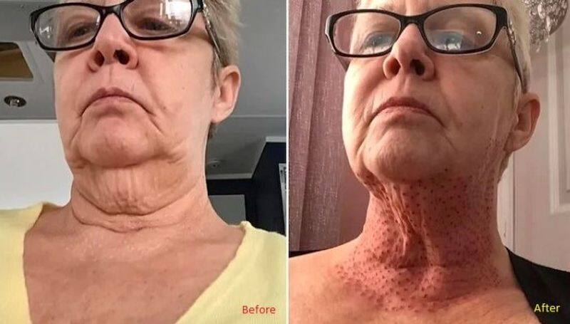 woman with lizard neck After Botched Double Chin Surgery in uk apa 