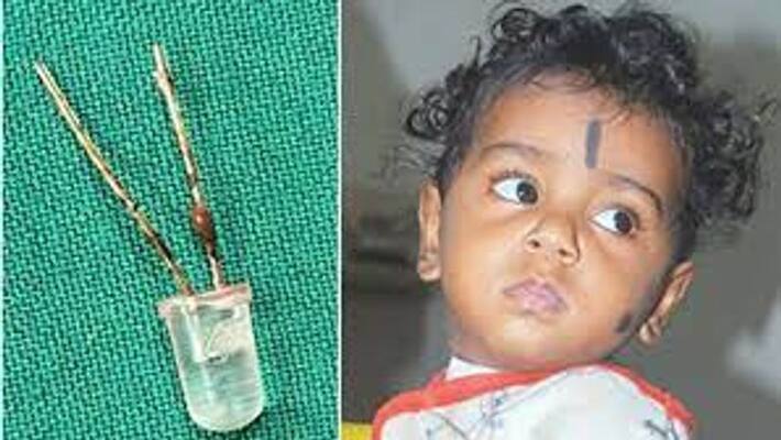 Child swallowed LED bulb - doctors surgically remove it from baby's s Child swallowed LED bulb - doctors surgically remove it from baby's s